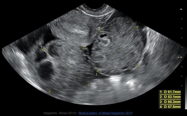 <p>The image displayed is from pelvic ultrasound from a 27yr old female complaining of pelvic fullness. The findings on the image are consistent with:</p><p>A. ovarian lymphoma</p><p>B. Krukenberg tumors</p><p>C. ovarian hyperstimulation syndrome</p><p>D. bilateral endometriomas</p>