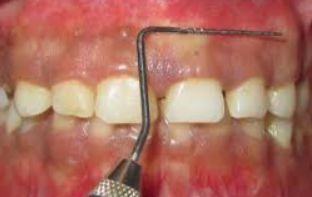<p>Area where mucosa meets attached gingiva</p>