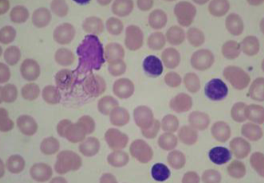 <p>Damaged white blood cells</p>