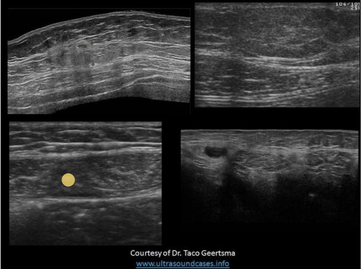 <p>Top left is a benign mass with lobulated borders and the top right is a lipoma. Both are located in the subcutaneous tissues/fat between the skin and the anterior rectus sheath. The lipoma has smooth borders and an echogenicity similar to the surrounding fat. </p><p>The bottom right image demonstrates a spigelian hernia, between the right rectus abdominis and right oblique muscles. </p><p>The bottom left image demonstrates a hematoma in the rectus abdominis muscle, between the anterior and posterior rectus sheaths.</p>