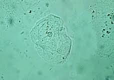 <p>epithelial surface involved or adjacent to collection site</p>