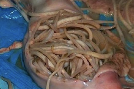 <p>What ascarid worm (first initial and species name) causes ascarid impactions and is also called the equine roundworm? It is an older foal and weanling disease, with immunity developing by 18-24 months. They will have a poor deworming history. Clinical signs include ill thrift, colic/depression, increased heart rate, increased respiratory rate, and fever. Diagnostics include history, FEC, gastric reflux with worms, and ultrasound of the abdomen. Treatment is via initial gastric decompression, anti-inflammatories, and usually surgery due to damage to the SI wall. Prognosis is poor with 10% long term survival due to adhesion formation.</p>