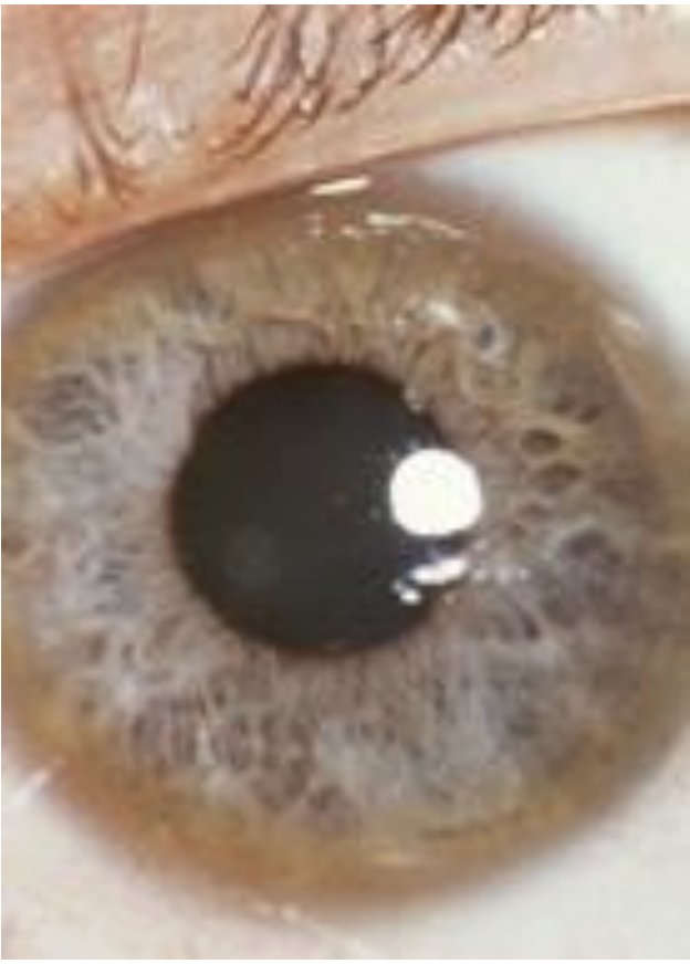 <p>copper accumulation in Wilson disease due to low level of what protein</p>