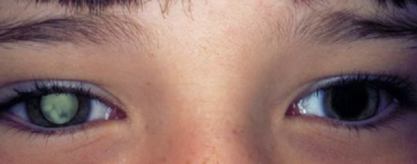 <p>De quoi pourrait souffrir ce jeune patient ?</p><p></p><p>A. ﻿﻿﻿Cataracte</p><p>B. Rétinoblastome</p><p>C. Décollement de rétine</p><p>D. Toutes ces réponses</p>