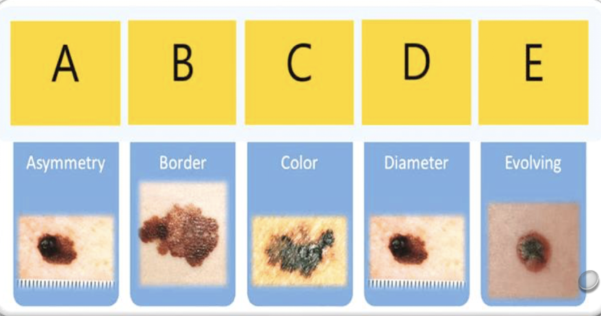 <p>Asymmetry </p><p>Border irregularity </p><p>Color change</p><p>Diameter greater than 6 mm</p><p>Evolving in appearance </p>