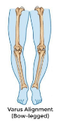 <p>Medial Knee</p><p>Bowlegged appeance</p>