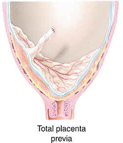 <p>Placenta previa. this will present with lil cramping lose of mucus plug and bleeds without pain.</p>