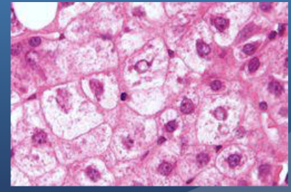 <p>A traveler from Ghana presents with fever, jaundice, and hematemesis (“black vomit”). Labs show elevated AST/ALT. Liver biopsy reveals apoptotic hepatocytes. Which of the following viruses is the most likely cause?</p>
