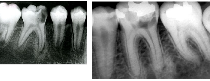 <p>idiopathic osteosclerosis differential diagnosis</p>