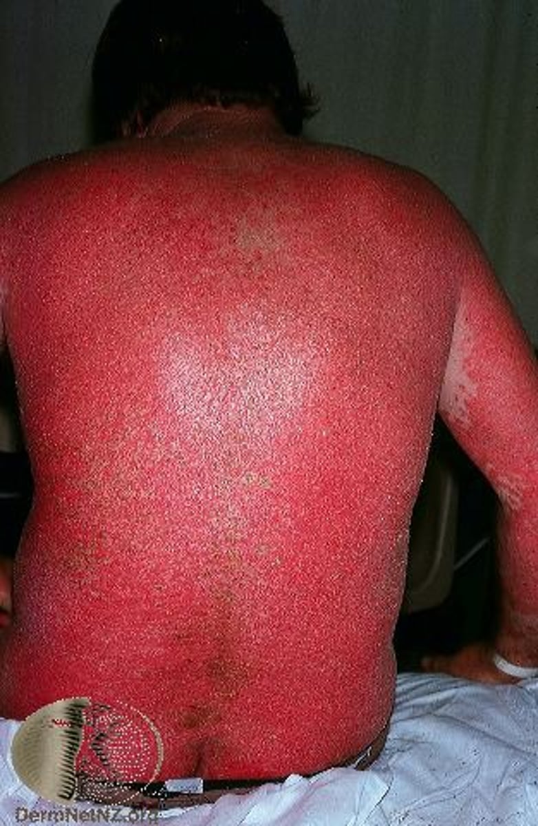 <p>intense and widespread reddening of the skin</p>