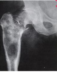 <p>Malignant tumor of the cartilage, Usually occurs in the pelvis & long bones of men older than 45years, May be removed surgically</p>