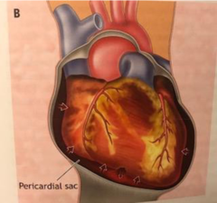 <p>When a penetration or lac of the cardiac muscle allows blood to leak from the heart into the pericardial sac, causing pressure to build around the heart</p><p>Built up pressure prevents the heart from adequately filling & emptying</p><p>Decreased CO</p><p>Results in hypoxia</p>
