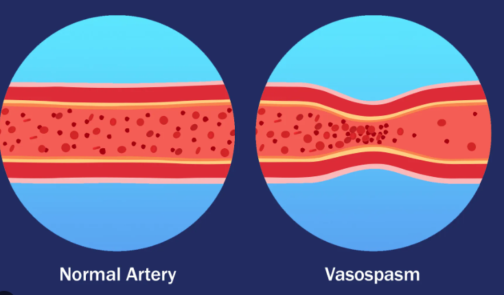 <p><span style="background-color: transparent;">Occurs in response to a damaged vessel. Blood vessels have a smooth muscle layer that constricts when the vessel is damaged. Platelets release serotonin, which facilitates the construction of the vessel. This action helps to stop bleeding.</span></p>