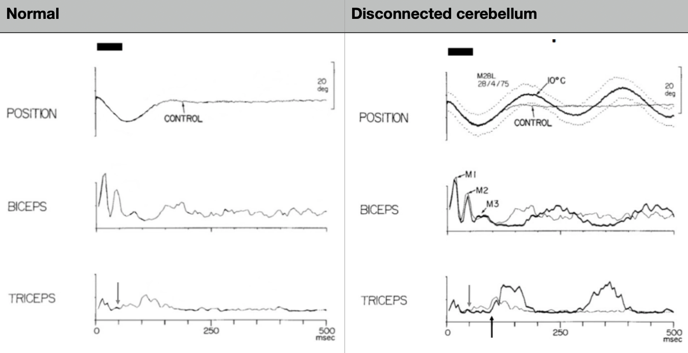 <p><span>The </span><strong>spinocerebellum</strong><span> receives massive proprioceptive/somatosensory data from the spinal cord to coordinate movement stability.</span></p><p></p><p><strong>Monkey experiment (Vilis &amp; Hore 1977):</strong></p><ul><li><p><span>Normal: when a weight is added, bicep stretch reflex fires AND spinocerebellum simultaneously sends a preparatory contraction to the triceps as a 'brake'</span></p></li><li><p><span>With cerebellum cooled (disconnected): stretch reflex still occurs (spinal) BUT no feedforward signal to triceps → bicep contracts unopposed → arm overshoots, then oscillates wildly</span></p></li></ul><p><strong>Conclusion:</strong><span> Feedback reflex alone is insufficient; feedforward braking is mandatory for smooth stable movement. Without it → </span><em>dysmetria</em><span> and tremor.</span></p>
