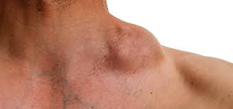 <p><strong>• Infectious mononucleosis risk factor</strong></p><p><strong>• In developed countries <u>40% of tumour cells contain virus</u></strong></p><p><strong>• Usually involves lymph nodes/abdomen</strong></p>