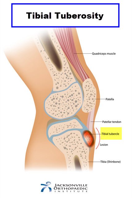 <p>Patellar tendon insertion; its medial third is the rotational landmark for tibial component alignment.</p>
