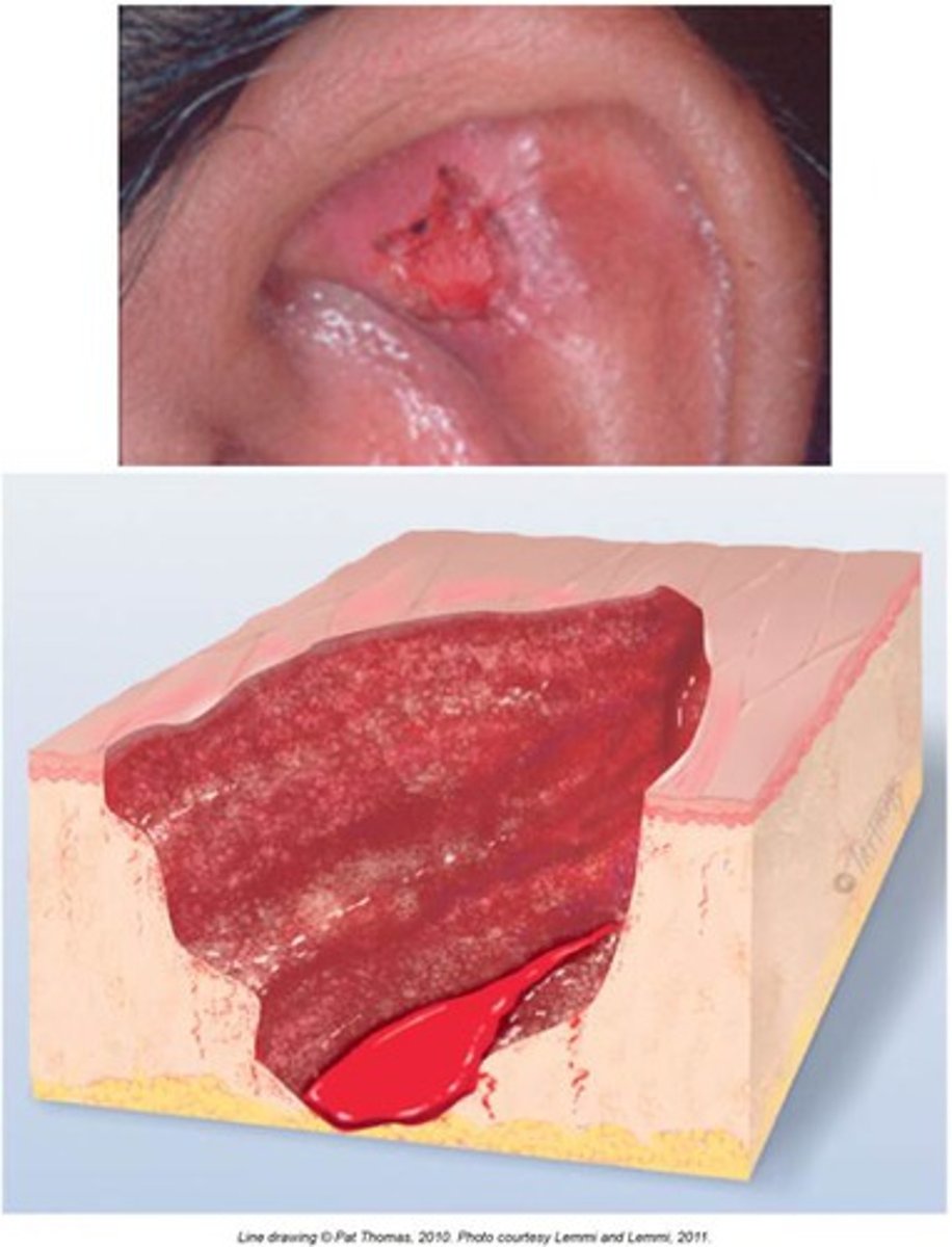 <p>It is characterized by piles of material on the skin surface, such as a crust or scab, or depressions in the skin surface, such as an ulcer.</p>