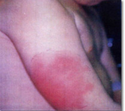 <p><span style="color: red;">localized inflammation</span> caused by immune complex deposition in vessel walls, alveoli. Type III  hypersensitivity</p>