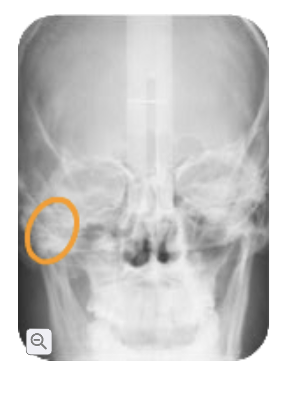 <p>Zygoma</p>