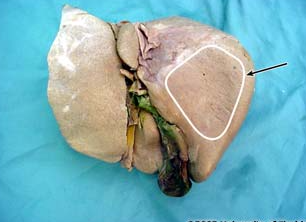 <p>what impression is being highlighted on the liver?</p>
