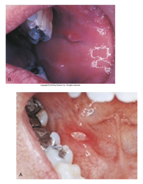 <p>Minor Apthous Ulcer “canker sore”</p>