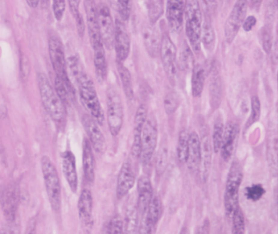 <p>A high power histology image of a leiomyosarcoma- List the key findings in a leiomyosarcoma that are absent from a leiomyoma.</p>