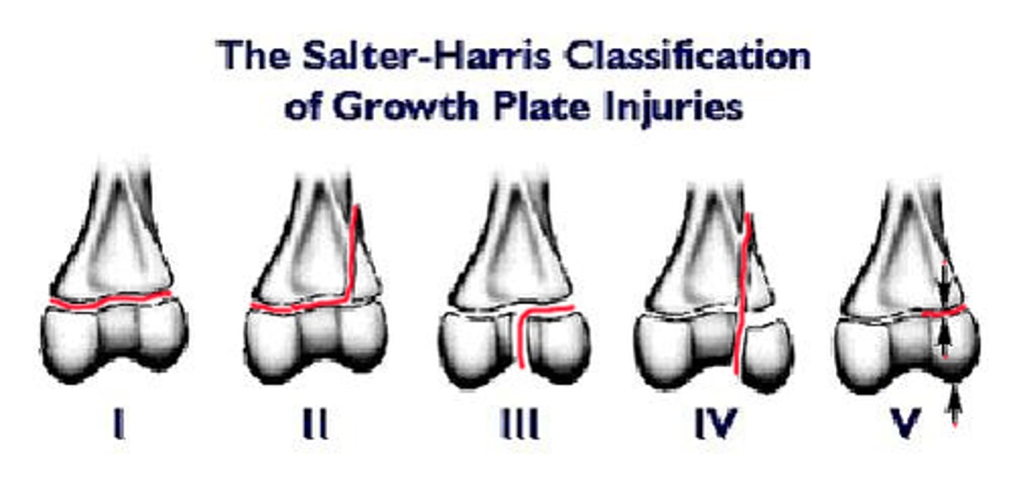 <p>used to characterize pediatric fractures thru epiphysis, physis (growth plate), and metaphysis</p><p>- higher the classification the higher the risk for complication</p>