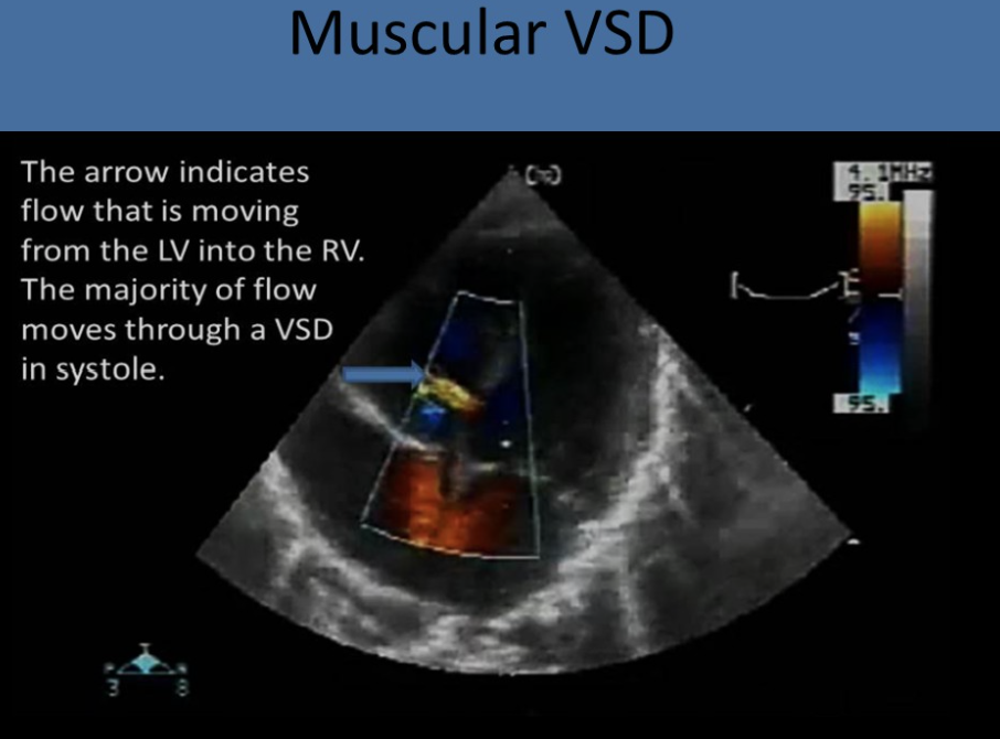 <p>muscular/trabecular</p>