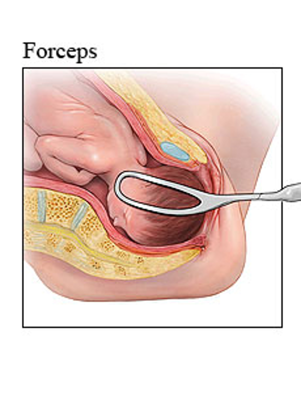 <ul><li><p><span><span>Two metal blades placed around fetal head → traction applied</span></span></p><ul><li><p><span><span>Can also rotate fetal head</span></span></p></li><li><p><span><span>Used less commonly</span></span></p></li></ul></li></ul><p></p><p></p>