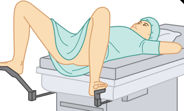 <p><span>the patient’s feet are placed in stirrups attached to the end and sides of the table</span></p><p><span>After the feet are in place in the stirrups, the patient is instructed to slide down until the buttocks are positioned at the edge of the table. The patient is draped from under the arms to the ankles. This position is used for vaginal examinations, often requiring the use of a vaginal speculum (an instrument used to hold open the walls of the vagina) and for obtaining cell samples of the cervix</span></p>