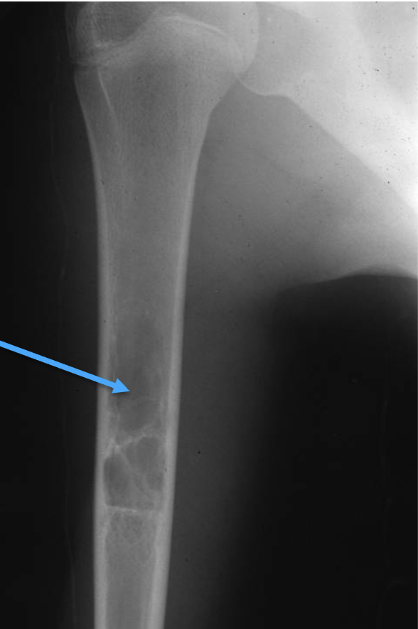 <p>What bone tumour is this, what bone is it in and what can be seen?</p>