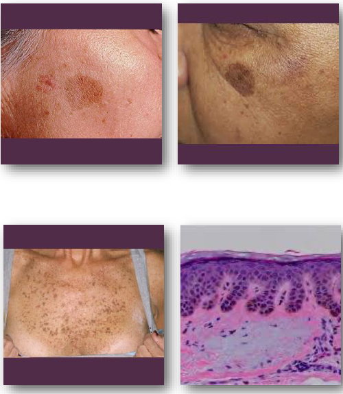 <p>• No treatment required for typical lesions</p><p>• Biopsy if lesion appears irregular or changing</p><p>• Sun protection reduces new actinic lesions</p><p>• Cosmetic removal may be performed if desired</p><p>• No malignant transformation potential exists</p>