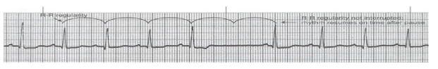 <p>Identify:<br>a. sinus block<br>b. sinus arrest<br>c. 1st degree heart block<br>d. sinus arrhythmia </p>
