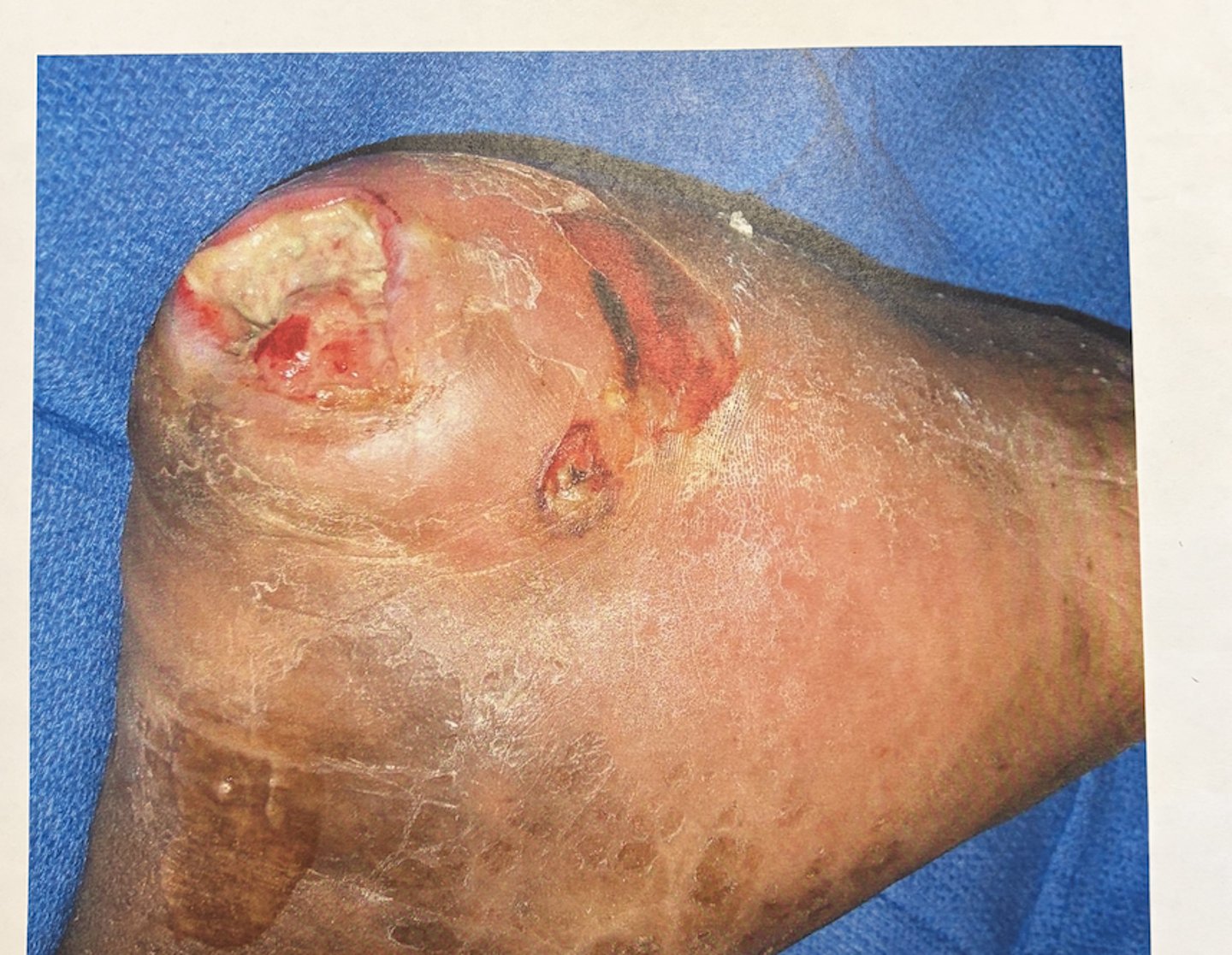 <p>what type of wound is this?</p>