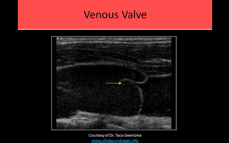 <p>genetic</p><p>history of venous thrombosis</p><p>venous hypertension (caused by valve damage or dysfunction) </p>
