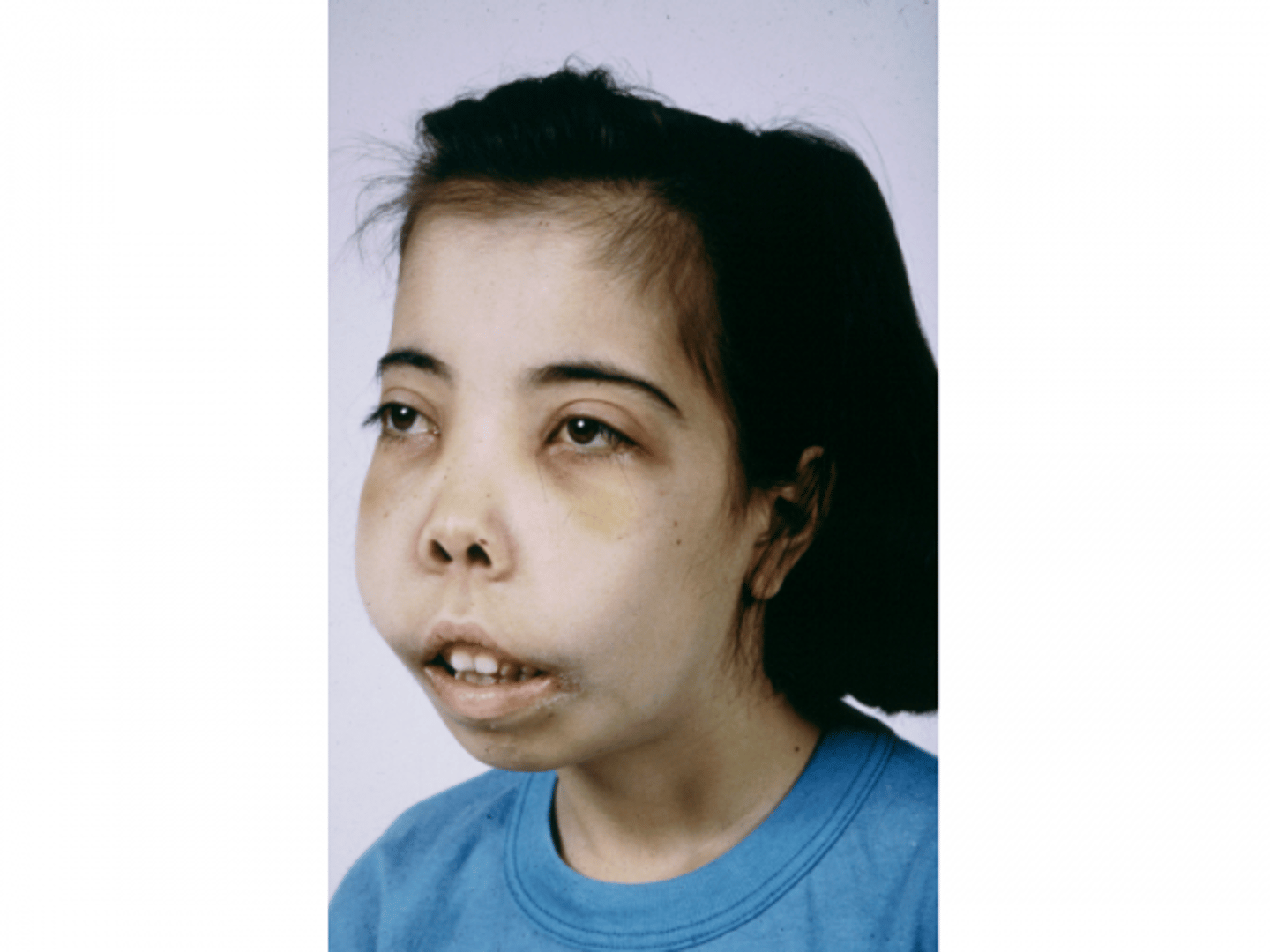 <p>- Its condition is a severe anemia resulting in weakness, fatigue, and frequent illness; usually fatal in adolescence or young adulthood</p><p>- Those who are at risk are primarily families of Mediterranean descent</p><p>- It can be treated with frequent blood transfusions</p>