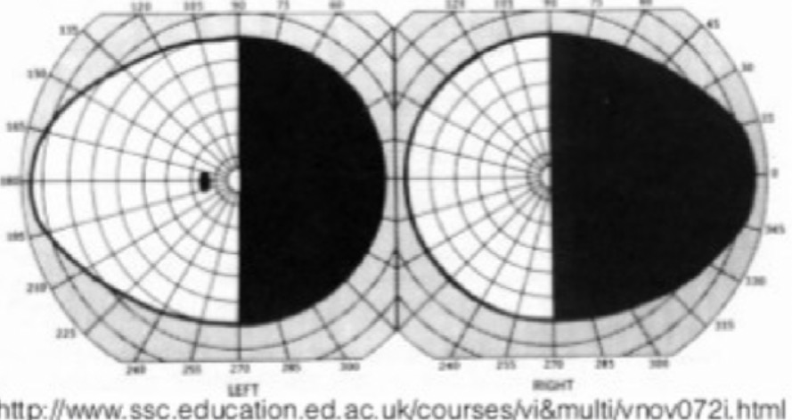 <p><span>Par quoi peut être causé ce déficit au champ visuel ?</span></p><p></p><p><span>A. Un prolactinome</span></p><p><span>B. Une lésion frontale gauche</span></p><p><span>C. Une lésion occipitale droite</span></p><p><span>D. ﻿﻿﻿Une lésion pariétale gauche</span></p><p><span>E. Une lésion rétinienne nasale de l'œil droit</span></p>