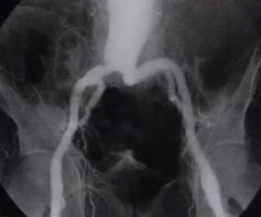 <p><span>Of the following choices, what is the most frequent complication from the disease process represented in the image?</span><br><br><span>A. Vasospasm</span><br><br><span>B. Rupture</span><br><br><span>C. Acute occlusion</span><br><br><span>D. Compartment syndrome</span></p>