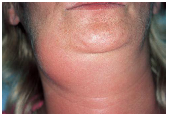 <p>sialadentitis</p>