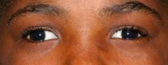 <p>History & PE - visual acuity, cover-uncover test</p><p>Treatment: Patching or surgical correction</p>