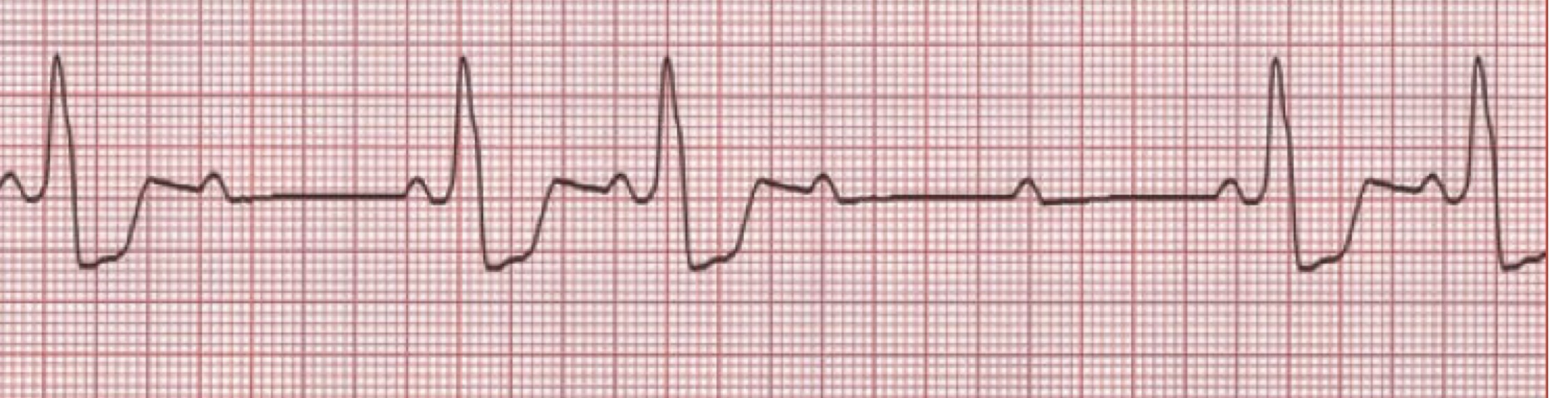 <p>What rhythm/abnormality is seen below?</p>