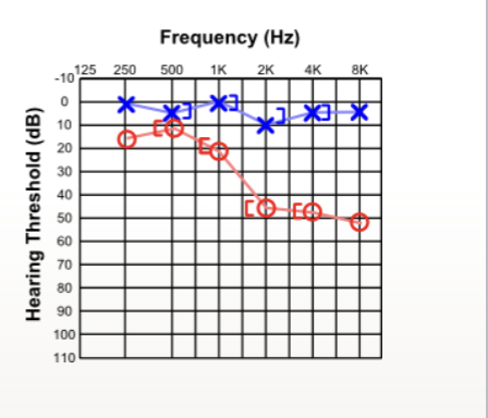 <p>what type of hearing loss</p>