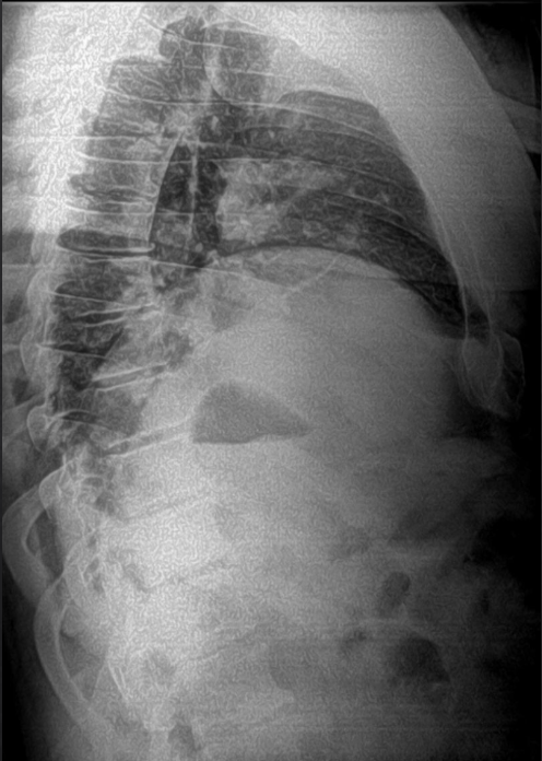 <p>Is this film of diagnostic quality (Lateral Thoracic)</p>