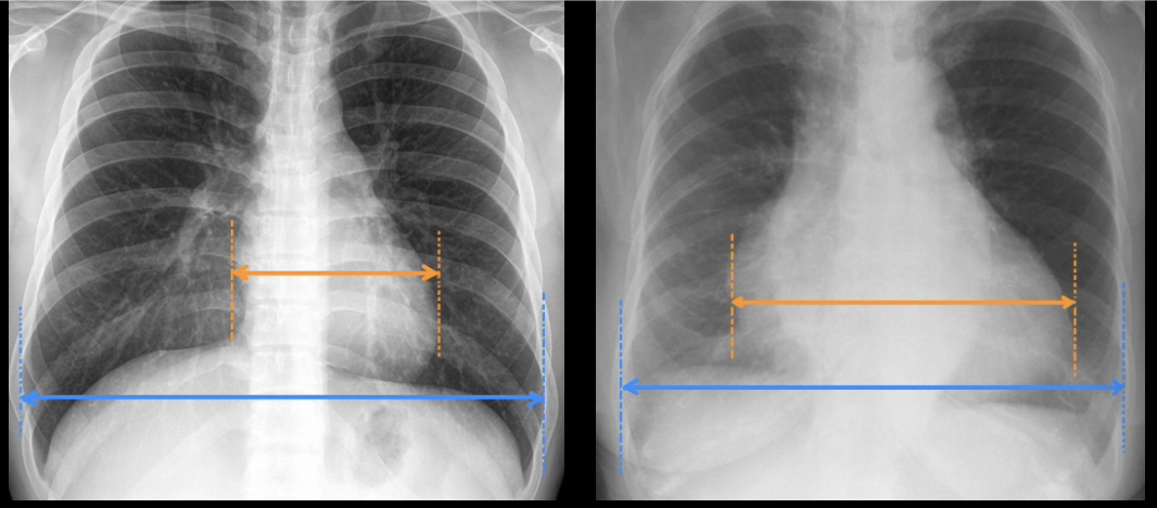 <p>Pathology (in right image)?</p>