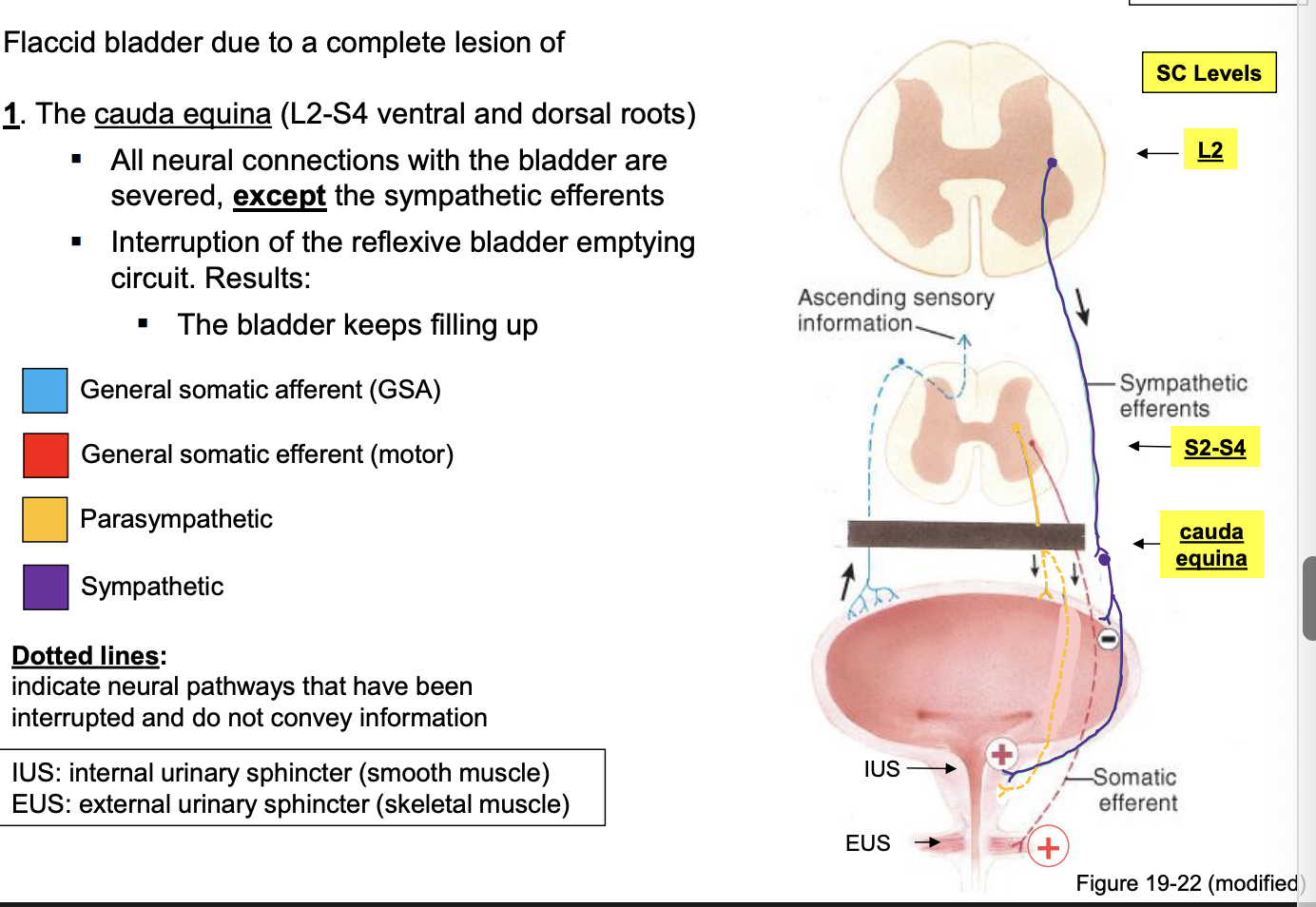 <p>flaccid bladder due to a complete lesion of: </p><ul><li><p>the cauda equina (L2-S4 ventral and dorsal roots) </p><ul><li><p>all neural connections with the bladder are severed, except the sympathetic efferents </p></li><li><p>interruption of the reflexive bladder emptying circuit. Results: </p><ul><li><p>the bladder keeps filling up </p></li></ul></li></ul></li></ul><p></p>