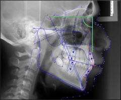 <p>What skeletal measurement:</p><p>- Sella-Nasion vs Nasion-A Point</p><p>- AP relationship between the cranial base and the maxilla</p><p>- Tells you about the AP position of the maxilla</p>