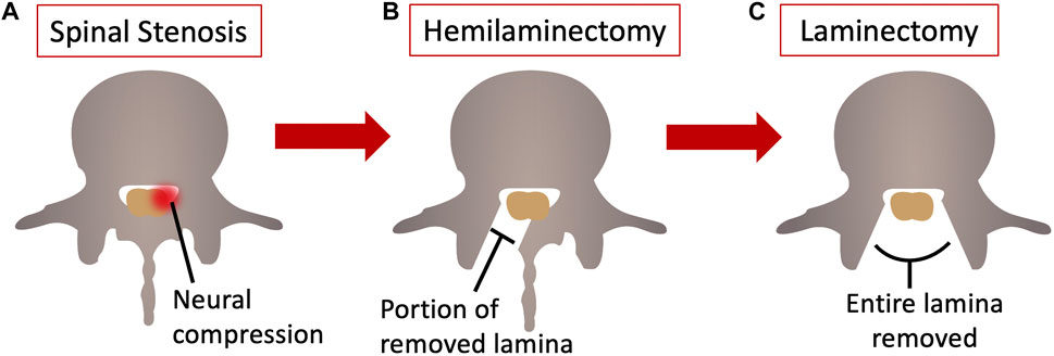 <p>Hemilaminectomy</p>