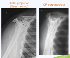<p>SID: 40inches</p><p>Grid: depends</p><p>kVp: 70-85</p><p>CR: 10-15° caudal angle, centered posteriorly to pass through humeral head (1in above midscapula)</p><p>Patient position: erect or recumbent, rotate patient until imaginary line between AC and superior angle is perpendicular to IR, angle may be 45-60° LAO/RAO</p><p>Breathing instructions: suspend respiration during exposure</p><p>Evaluation criteria: Supraspinatus outlet open and in profile ,Demonstrates coracoacromial arch, Optimal exposure factors</p>