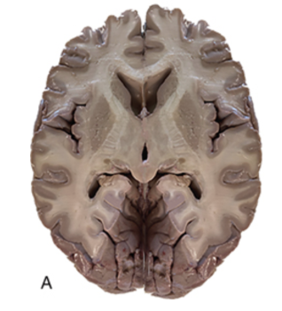 <p>viewed from the top of the head looking down</p>