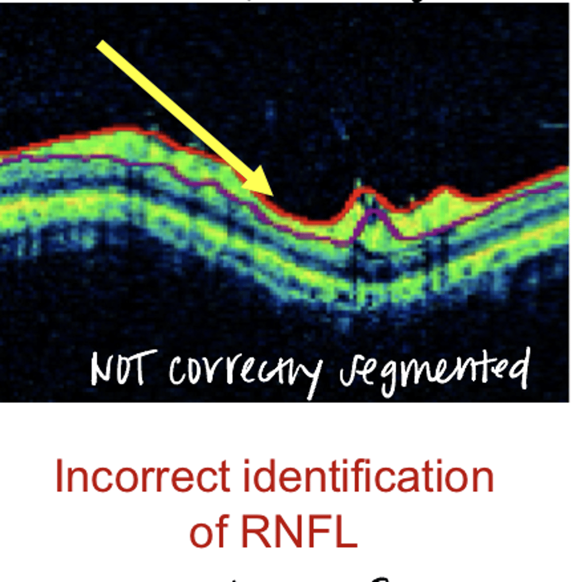 <p>Incorrect Identification of the RNFL (Pic)</p>